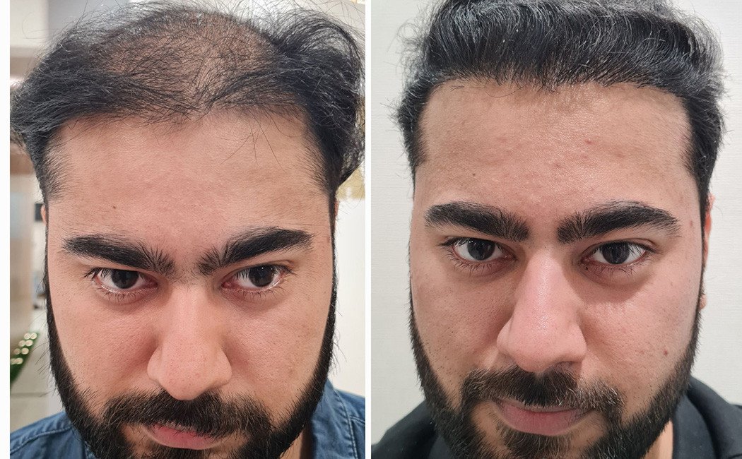 Hair Fall Treatment before and after